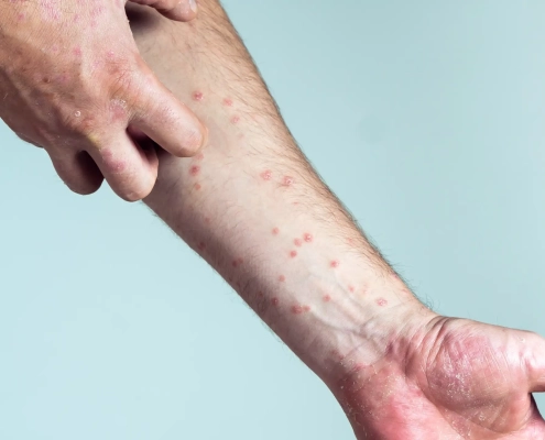 Bras avec éruption cutanée, démangeaisons visibles.
